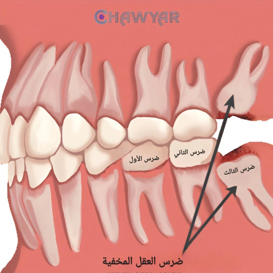 متى تكون إزالة ضروس العقل ضروريا