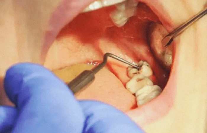 إزالة ضروس العقل