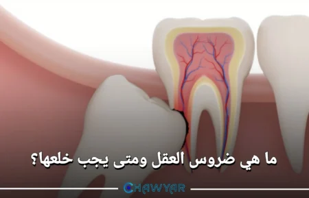 ما هي ضروس العقل