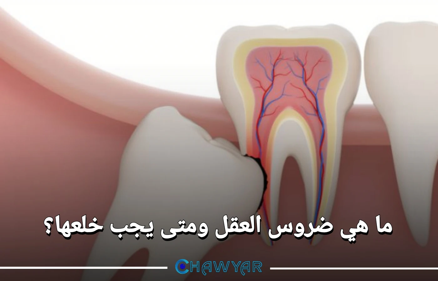 ما هي ضروس العقل