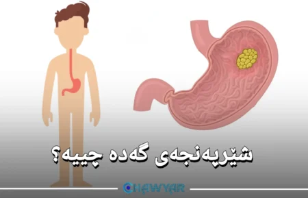 شێرپەنجەی گەدە چییە