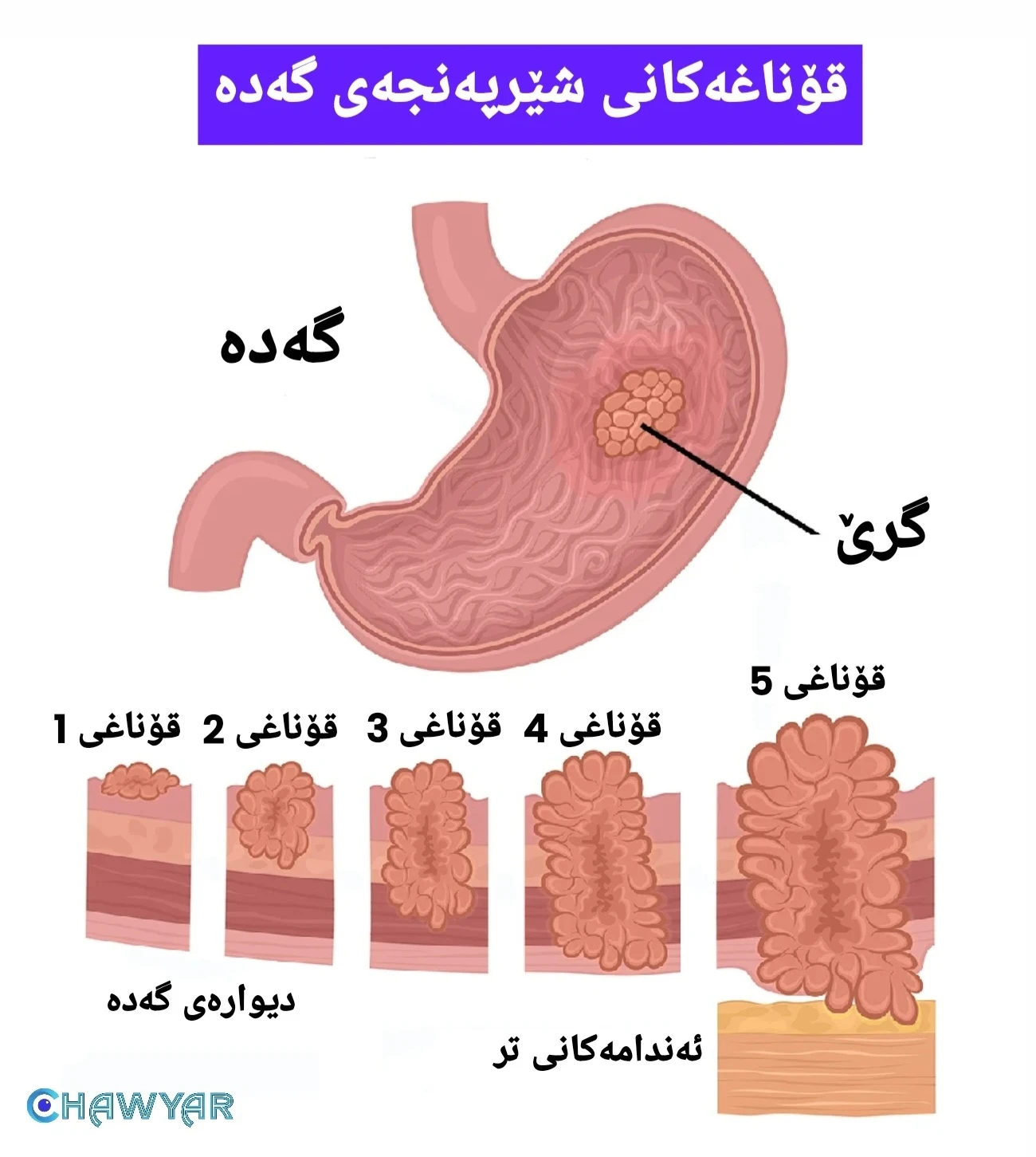 قۆناغەکانی شێرپەنجەی گەدە