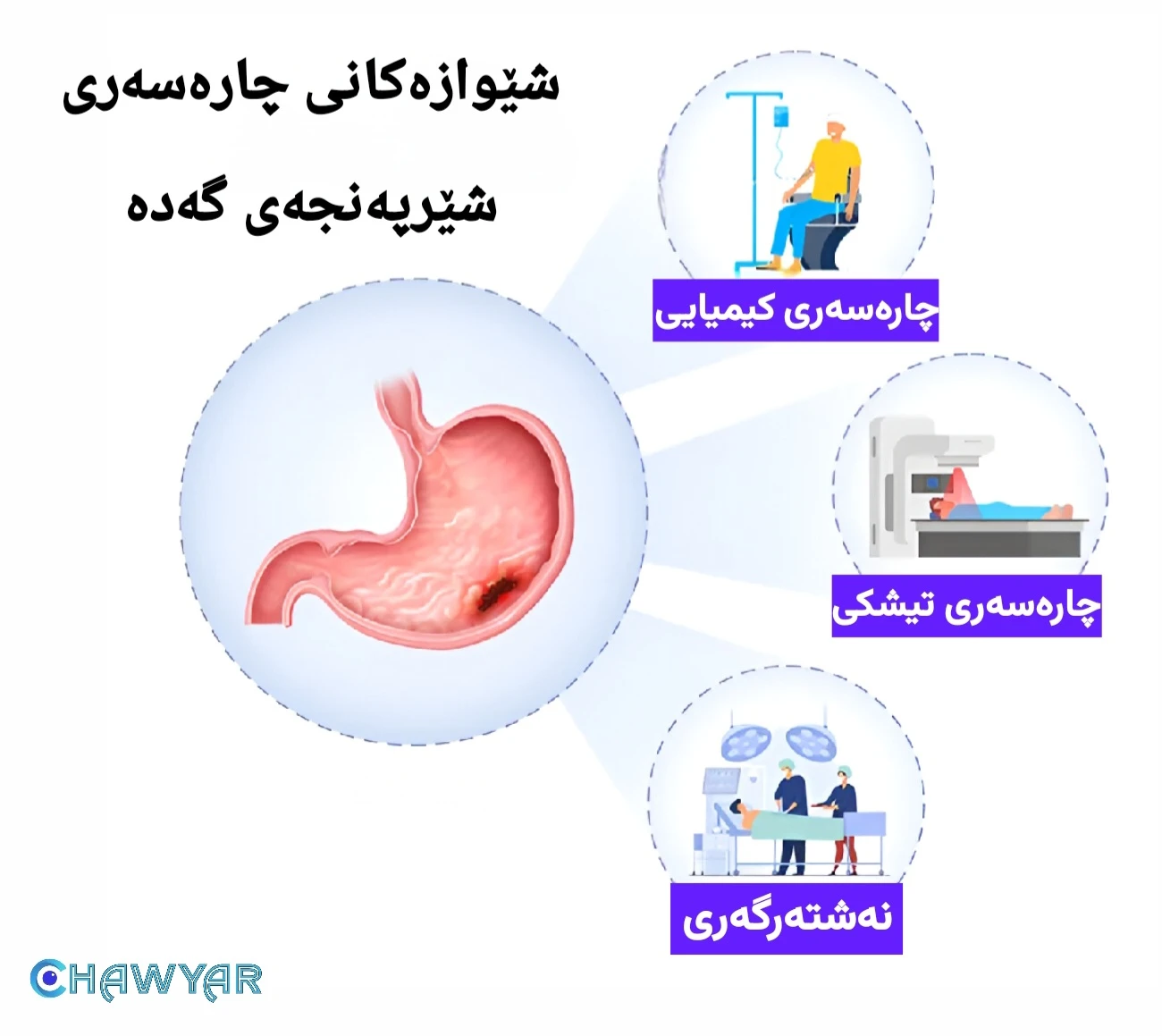 شێوازەکانی چارەسەری شێرپەنجەی گەدە