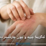 هۆکار و چارەسەری ئەگزیما